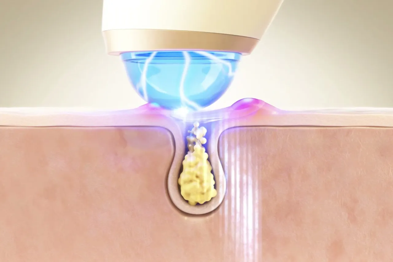오브제 플라즈마 부스트 기기 3D 영상, 피부 단면의 피지에 닿는 플라즈마 빛